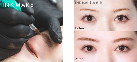 インクメニュー施術例